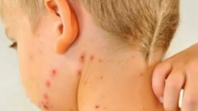 Kerala Witnesses Surge in Chickenpox Cases Amid Rising Temperatures