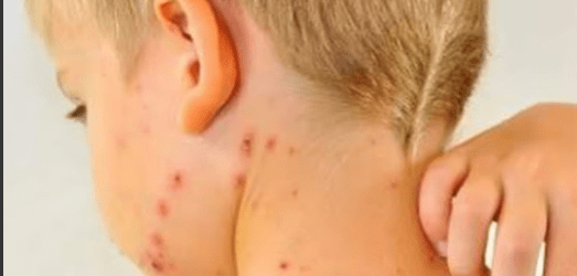 Kerala Witnesses Surge in Chickenpox Cases Amid Rising Temperatures